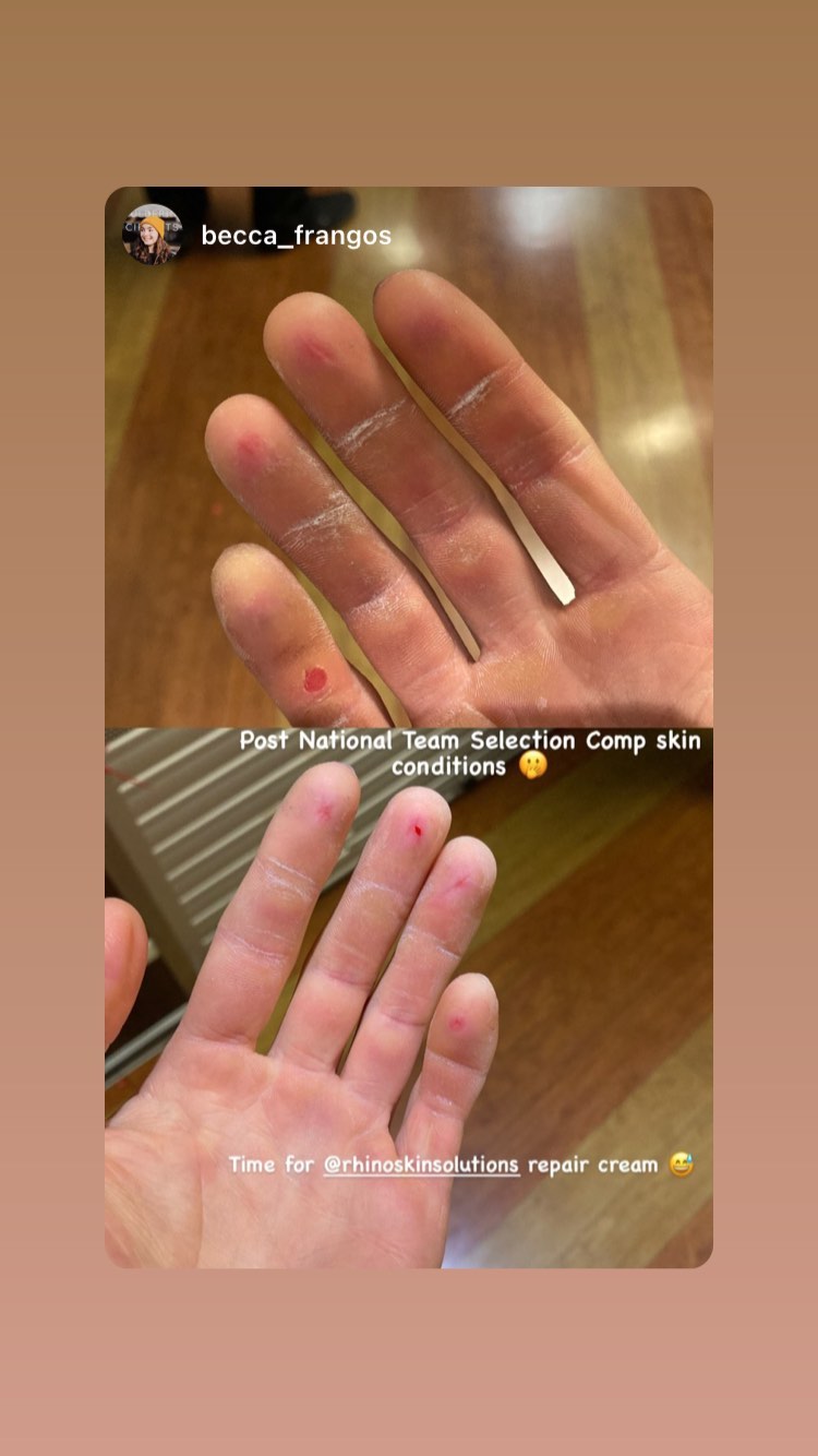 Climbing Skin Tears: How to Treat, Protect, and Prevent Them