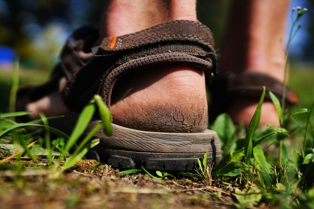 Cracked heel close-up — cracked heels and foot care by Rhino Skin Solutions